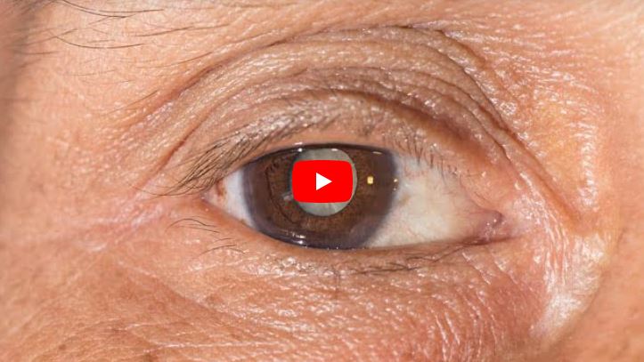 VÍDEO: Oftalmologista explica novas técnicas que facilitam tratamentos com pacientes acometidos de Catarata