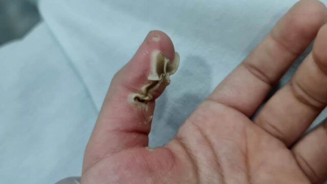Criança sofre queimaduras de segundo e terceiro grau após sofrer descarga elétrica em carregador de celular, em Patos 