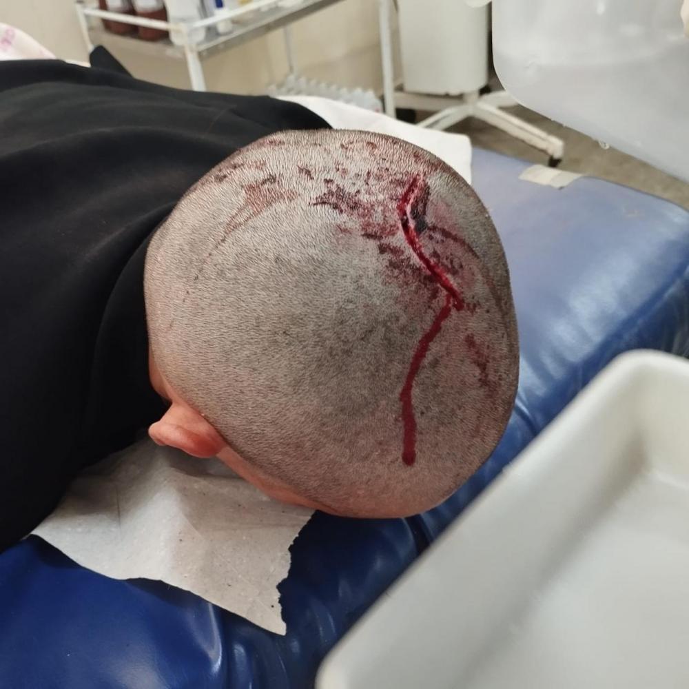 Mulher é brutalmente agredida e tem cabeça raspada pelo ex-marido, na Paraíba
