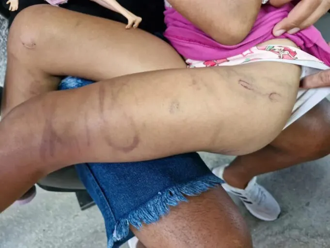 Criança espancada com chicote em Cabedelo teve dentes quebrados durante a agressão