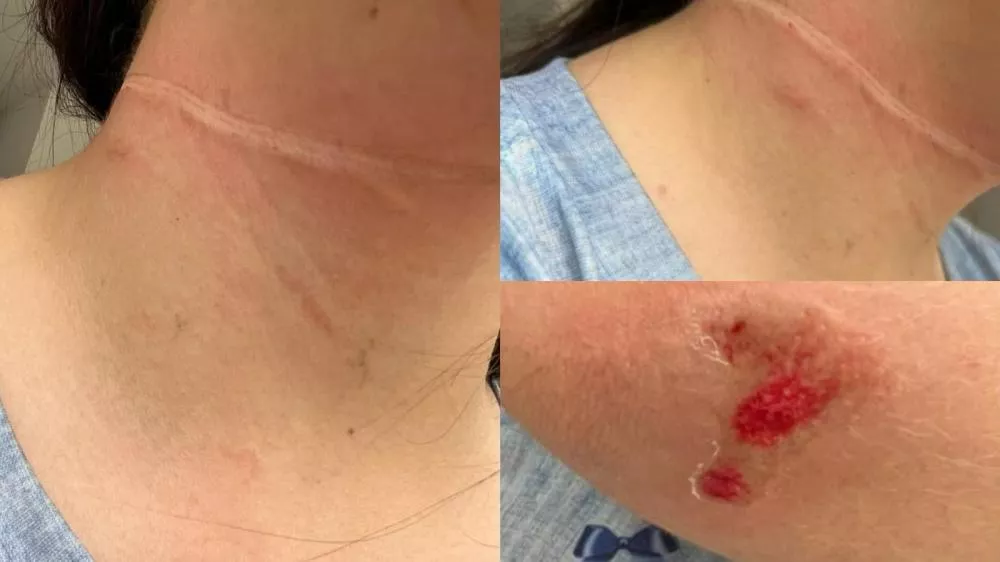 Jovem ciclista fica ferida após se enroscar em fios de internet soltos em Patos