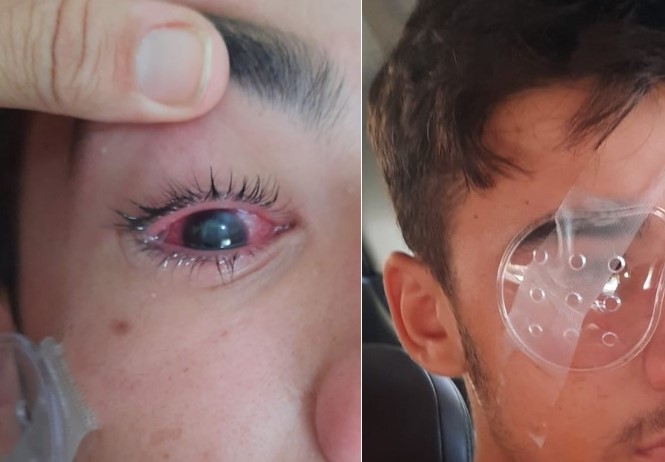 Jovem de 15 anos tem olho perfurado por fio de internet solto quando pedalava no centro de Patos