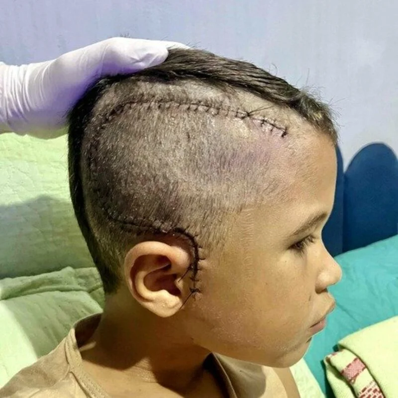 Família lança campanha para cranioplastia de menino de 7 anos residente em São José de Espinharas que sobreviveu a grave acidente