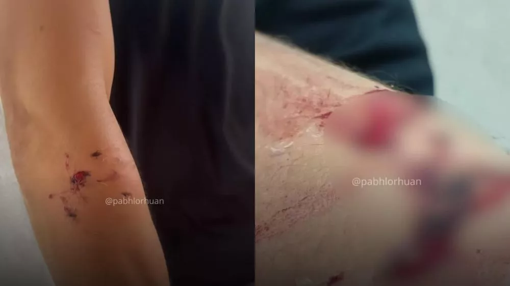 Motoboy é atacado por pitbull durante entrega em Patos; dono do cão não prestou socorro