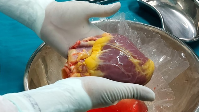 Hospital Metropolitano realiza 3º transplante cardíaco 100% SUS de 2023 com uso de equipamento inédito na Paraíba