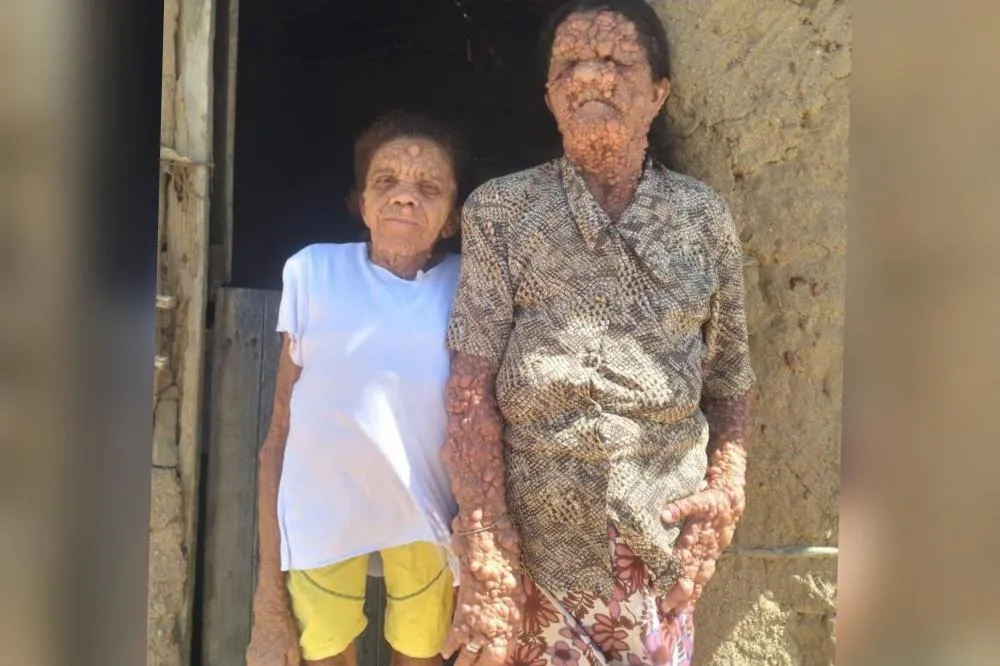 Neurofibromatose: mãe e filha na Paraíba convivem com doença rara que atravessa gerações: 'O povo se afasta da gente, mas entrego na mão de Deus’
