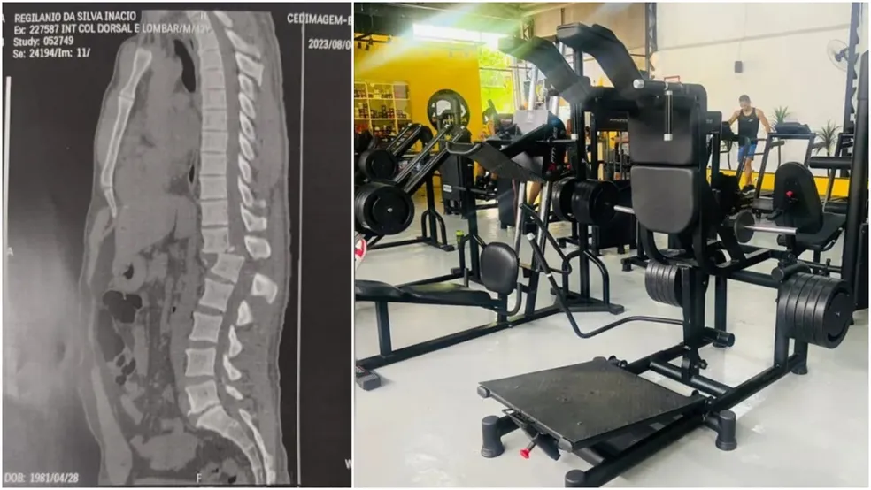Tomografia mostra lesão na coluna de homem atingido por aparelho em academia no Ceará
