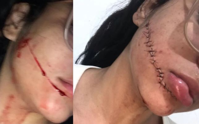 Pai da jovem que teve rosto cortado enquanto dormia em viagem de ônibus na BA pede justiça: 'Pode ser fatal'