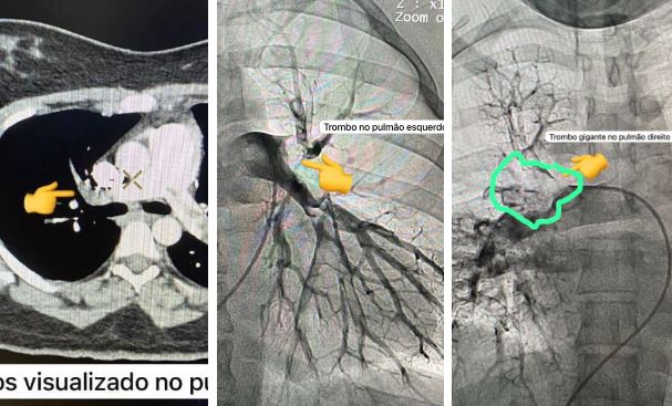 Trombectomia mecânica: Hemodinâmica de Patos realiza mais um procedimento inédito no Sertão da Paraíba