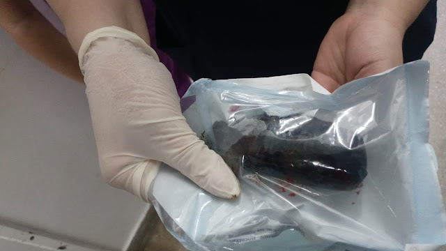 Mulher passa por cirurgia para retirada de droga escondida no ânus, no alto sertão da PB